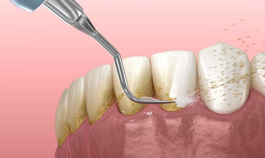 جراحة تجريف اللثة 