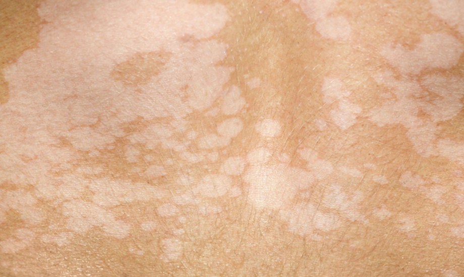 ما هي السعفة المبرقشة؟