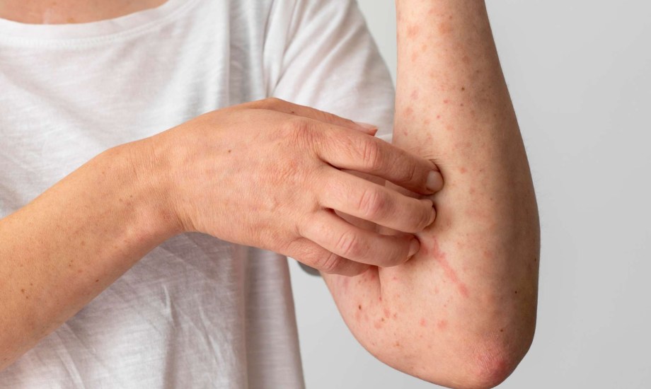 عوامل تزيد خطر الإصابة بالسعفة المبرقشة