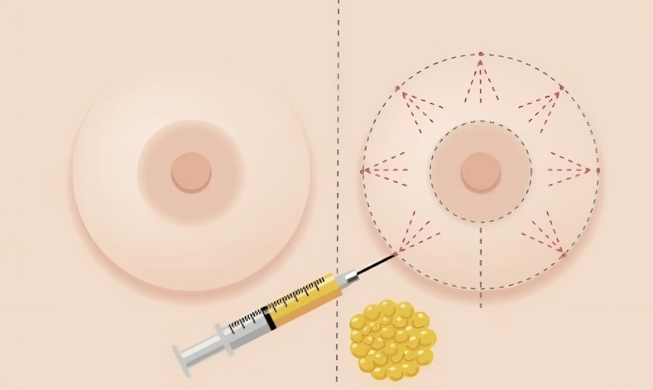 جراحة تكبير الثدي.. مخاطرها والفئات الممنوعة منها