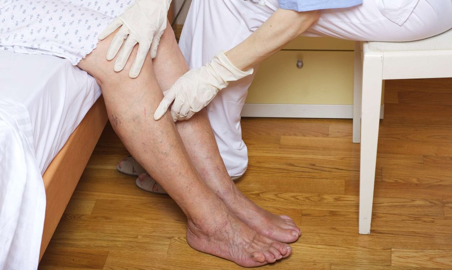 أسباب وطرق الوقاية من دوالي الساقين خلال الحمل