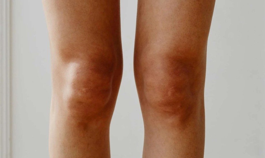 أسباب اسمرار الركبة وطرق علاجها