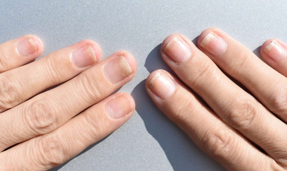 فطريات وصدفية الأظافر