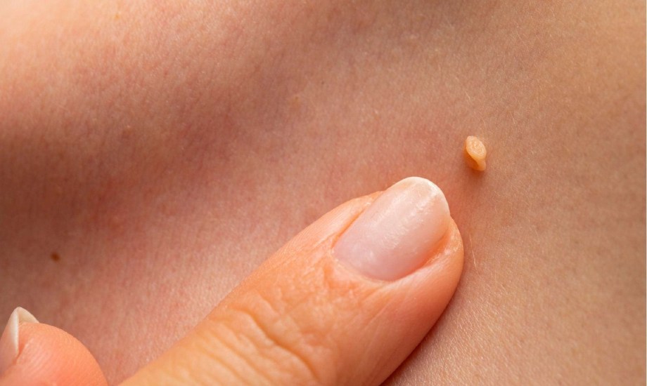 أنواع الثآليل وطرق انتشارها