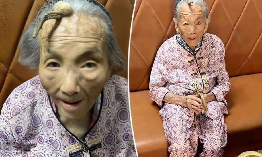 قرن على جبين امرأة يثير الجدل في الأوساط العلمية