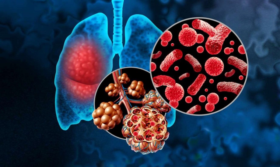 أسباب وأعراض التهاب الرئة المتنقل