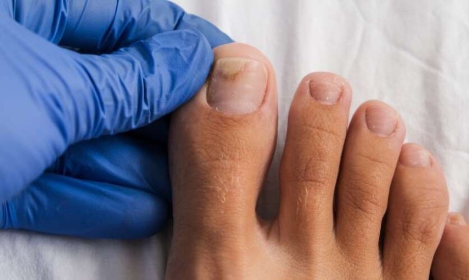 الأسباب الشائعة لسقوط ظفر القدم