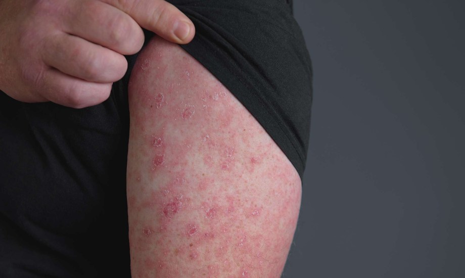 مضاعفات التهاب النسيج الخلوي