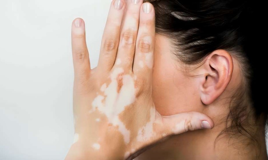 7 علاجات منزلية لمرض البهاق