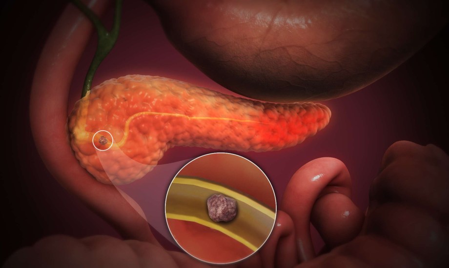 الوقاية من التهاب البنكرياس الحاد