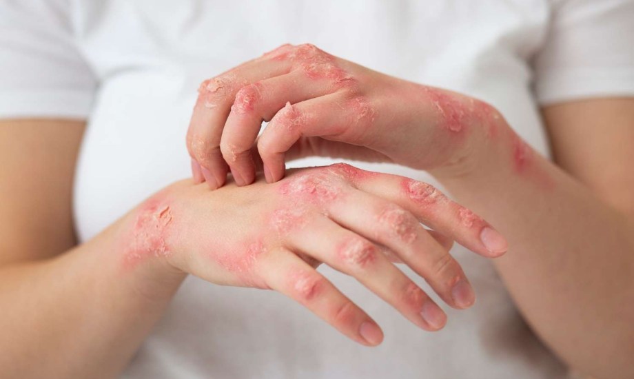 7 زيوت لتخفيف أعراض الصدفية