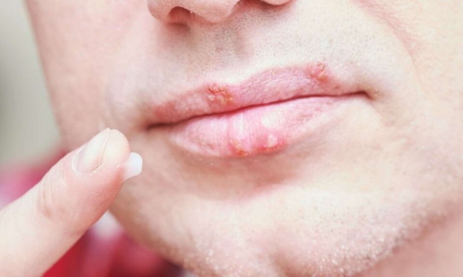 أعراض هربس الشفاه وأنواعه