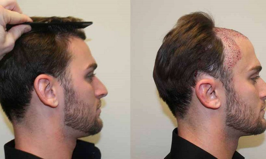 تركيا وجهة الرجال لزراعة الشعر