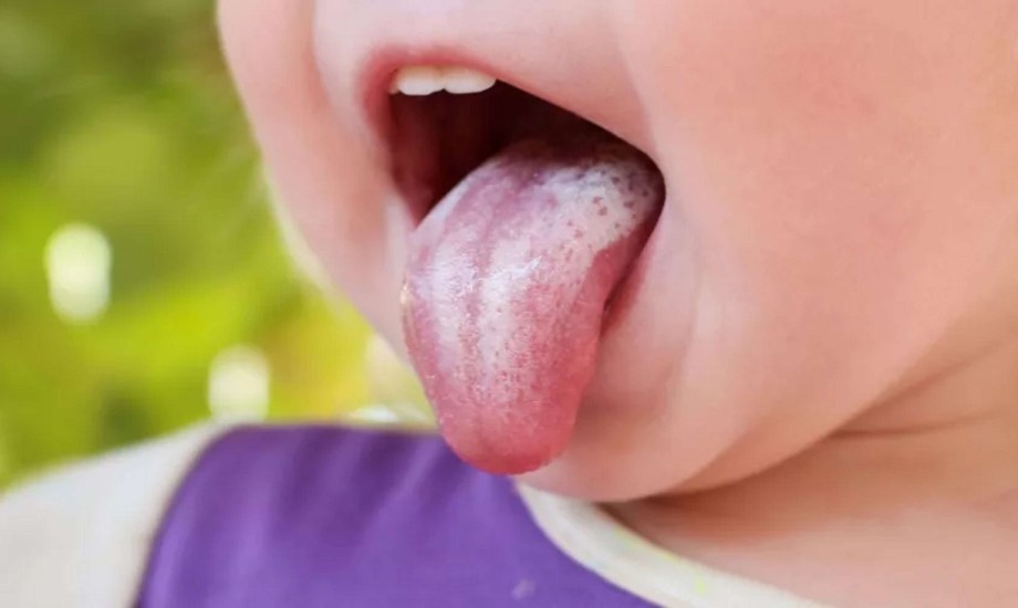 الفئات الأكثر عرضة للإصابة بالقلاع الفموي