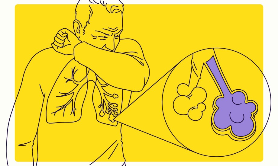 أسباب وأعراض الالتهاب الرئوي الفيروسي