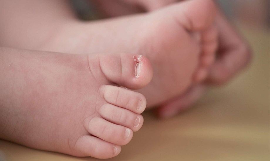 أعراض ظفر القدم الغائر في اللحم عند الأطفال