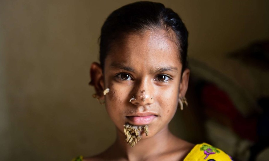 أسباب وأعراض متلازمة الرجل الشجرة