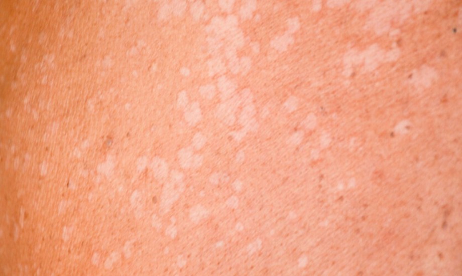 علاجات فعالة للطفح الجلدي الأبيض