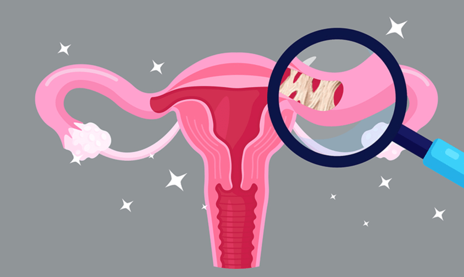 التهاب قناة فالوب