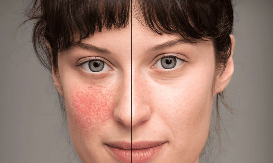 تلوث الهواء والذئبة