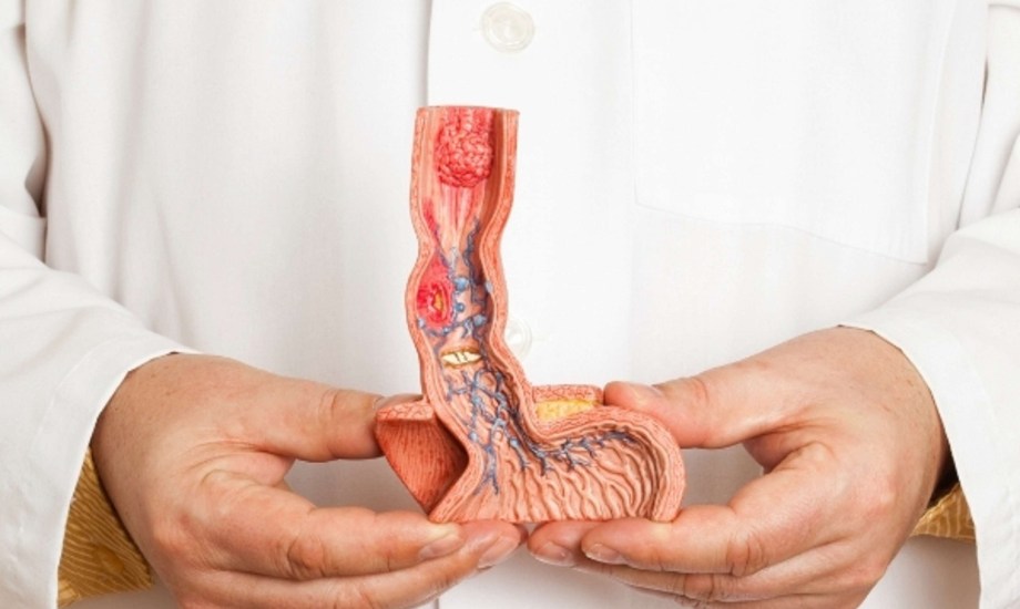 علاج وطرق تشخيص مريء باريت