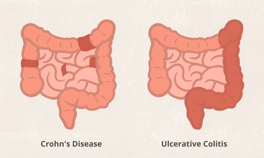 أدوية جديدة لعلاج التهاب القولون التقرحي