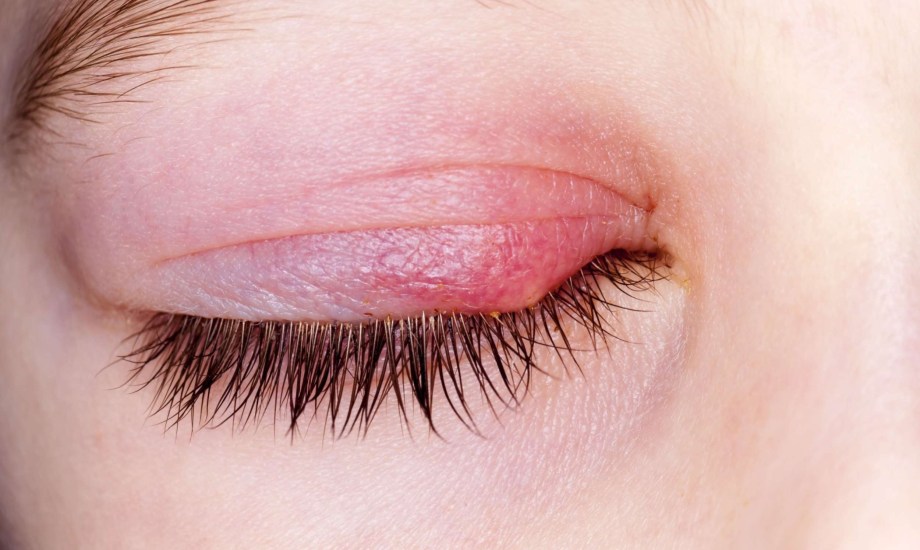 العلاجات المنزلية والطبية لتخفيف دمل العين