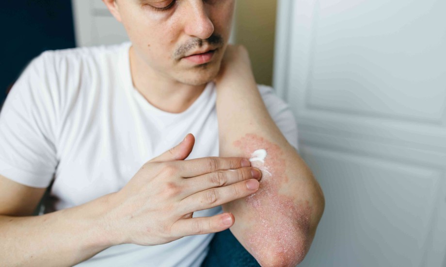 العلاجات الطبية والمنزلية التي تخفف من أعراض الجرب