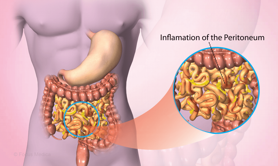 أسباب وأعراض التهاب الصفاق بالبطن