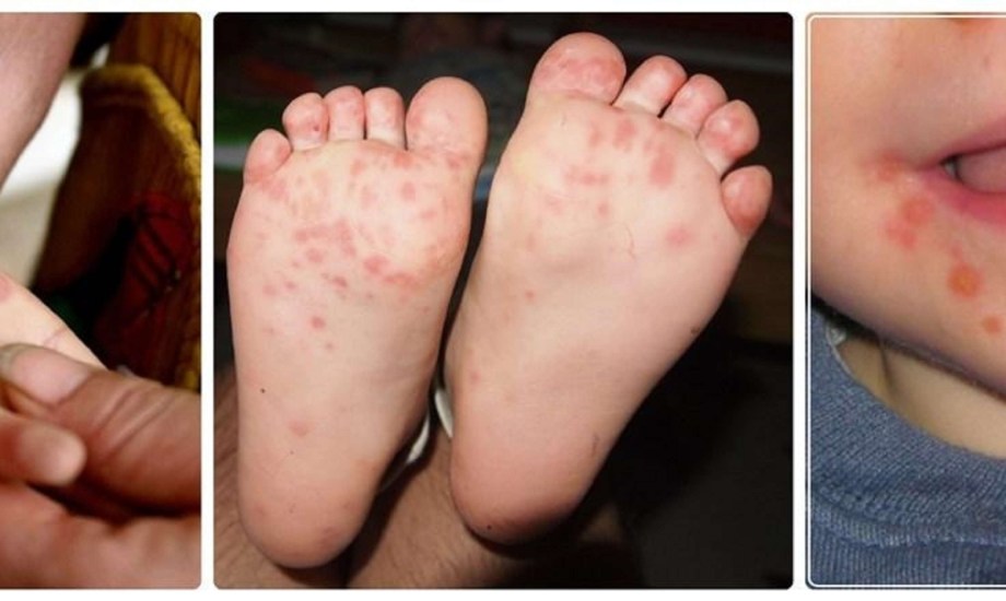 أسباب وأعراض مرض اليد والقدم والفم عند الأطفال