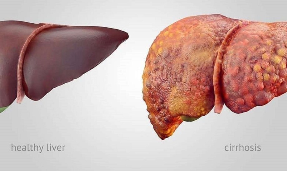 أسباب وأعراض وطرق علاج تليف الكبد