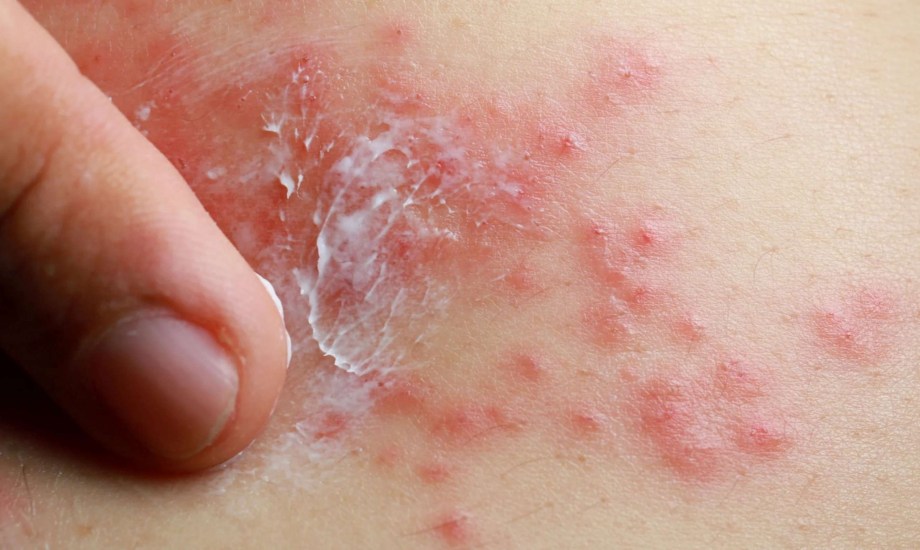 الإكزيما في المناطق الحساسة