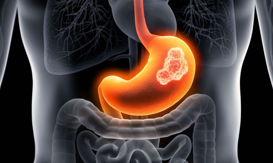 أسباب وأعراض سرطان المعدة