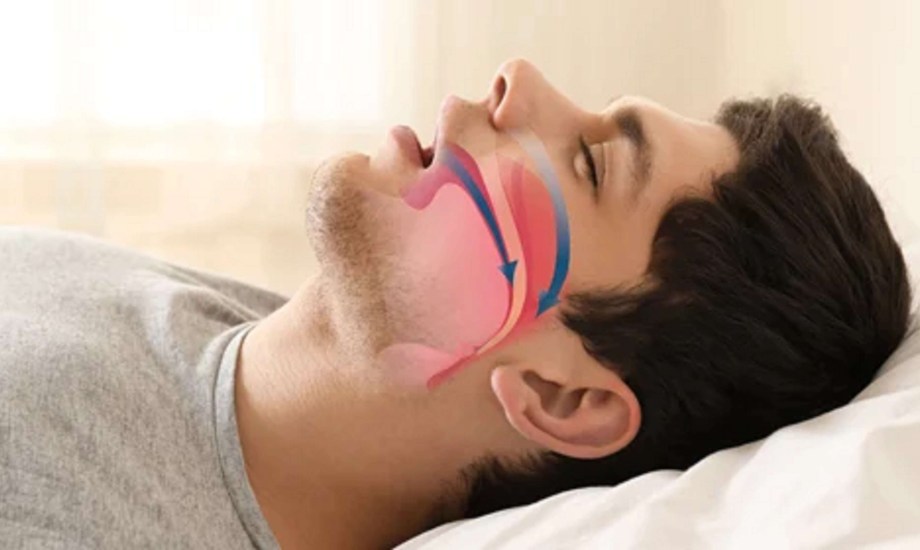 علاج انقطاع النفس الانسدادي أثناء النوم