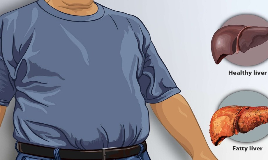 تأثير فقدان الوزن على الكبد الدهني
