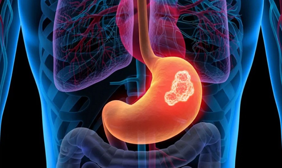 5 خيارات علاجية لسرطان المعدة