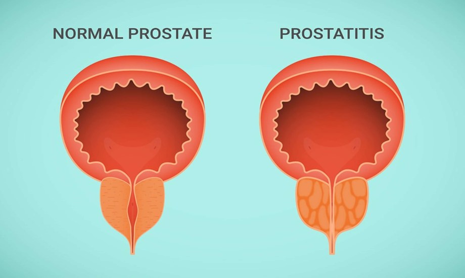 علاج تضخم البروستاتا من دون أدوية