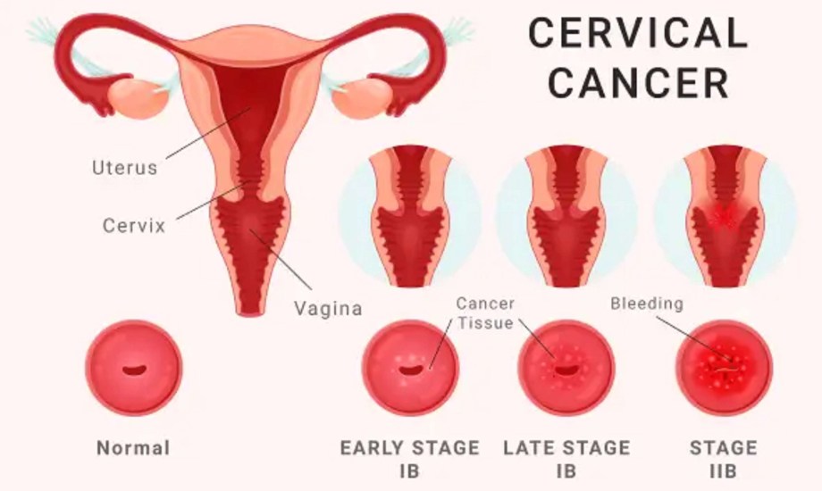 شهر التوعية بسرطان عنق الرحم
