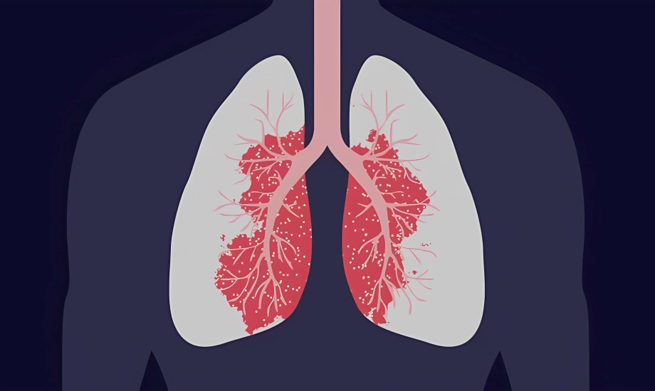 أطعمة تُسرع التعافي من الالتهاب الرئوي