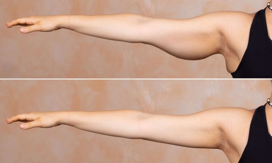 الفئات المستفيدة من عملية شد الذراعين