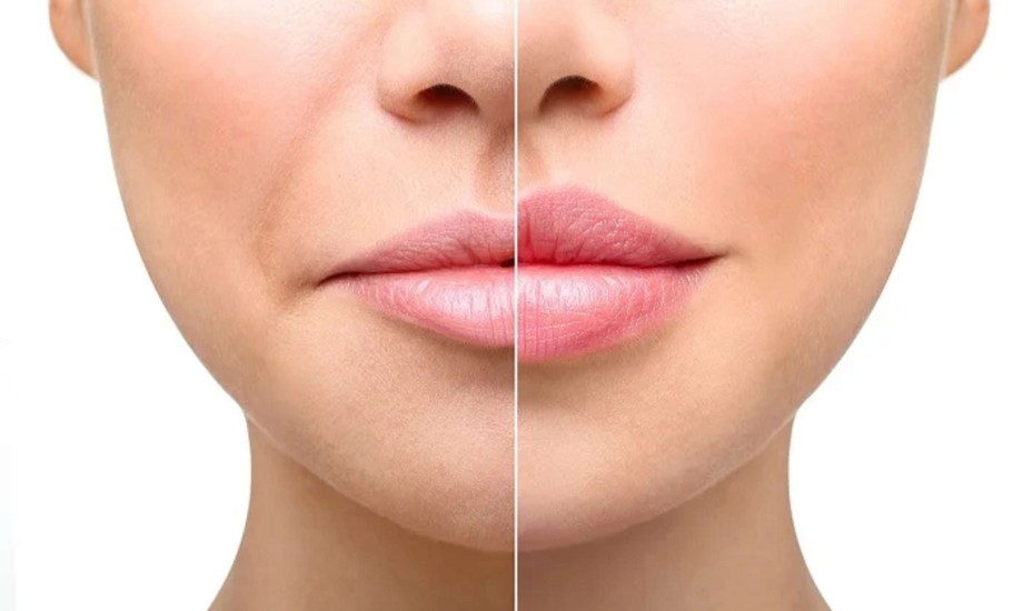 أنواع فيلر الشفاه
