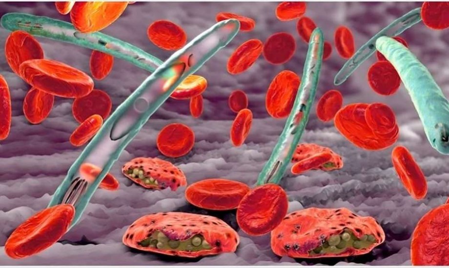 كل ما تحتاج معرفته عن الملاريا الدماغية