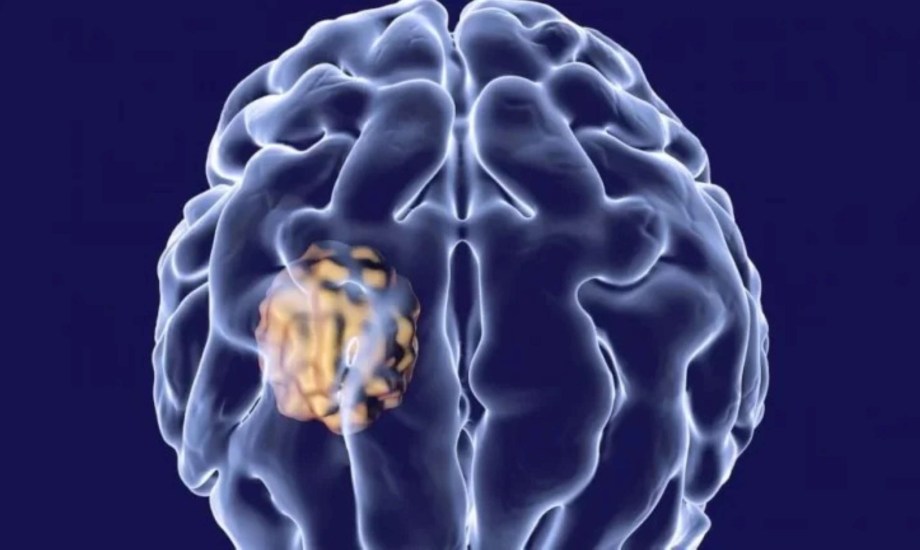 أسباب وأعراض خراج الدماغ وطرق التشخيص والعلاج