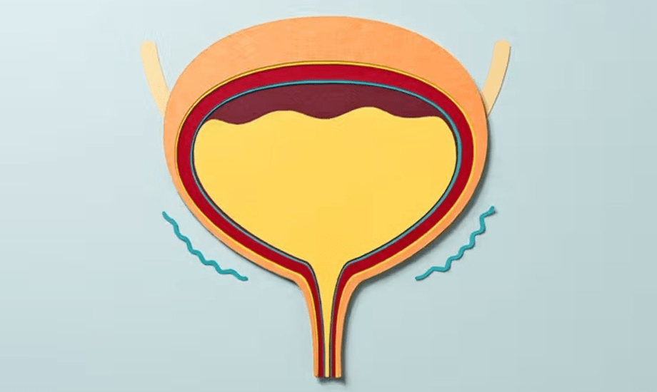 أسباب تشنجات المثانة وطرق العلاج