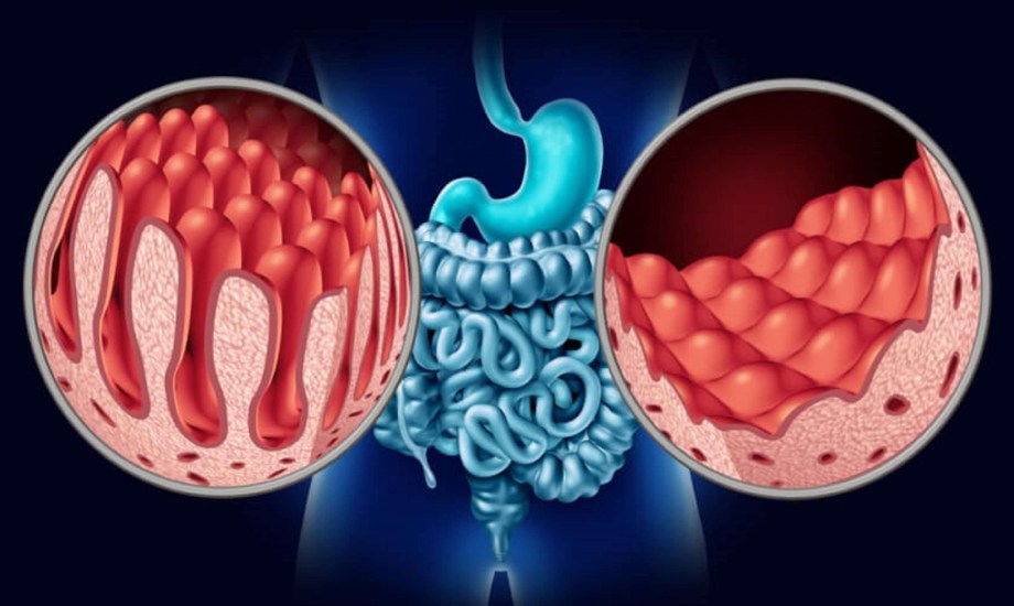 أعراض مرض السيلياك عند الرجال