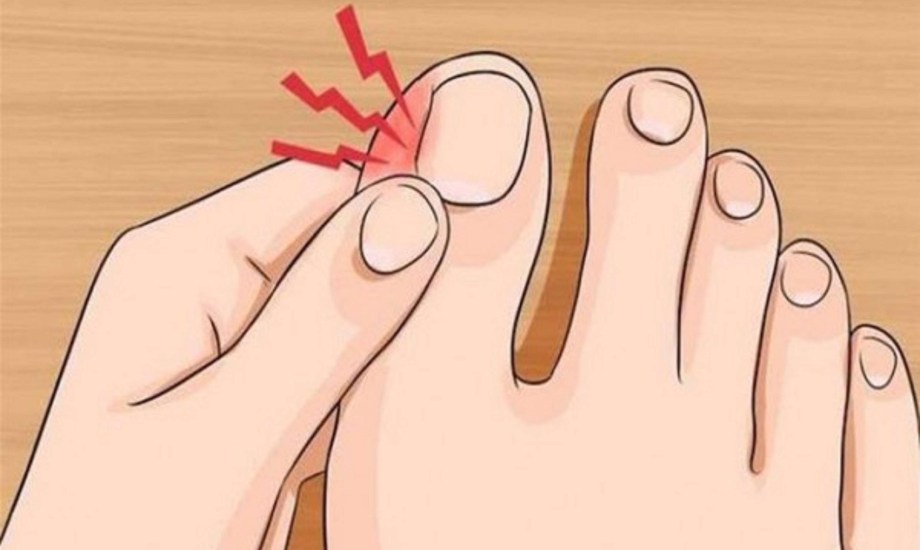 طرق علاج الظفر المغروس في الجلد