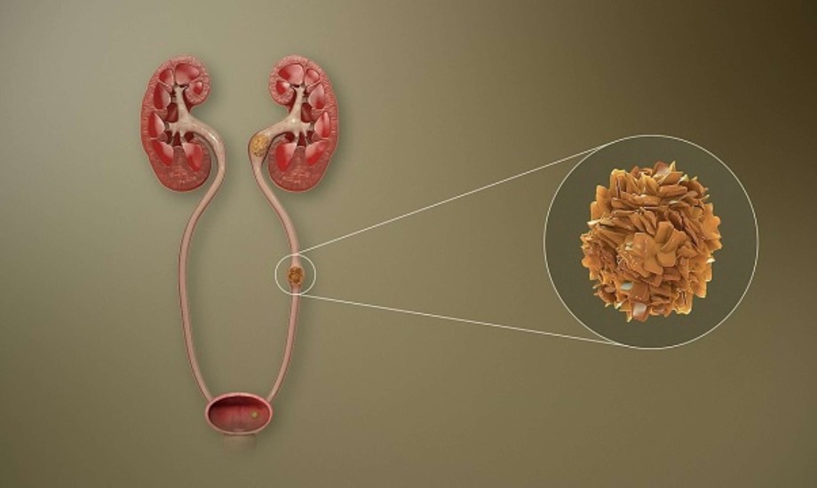 أعراض حصوات الحالب والفئات الأكثر عرضة