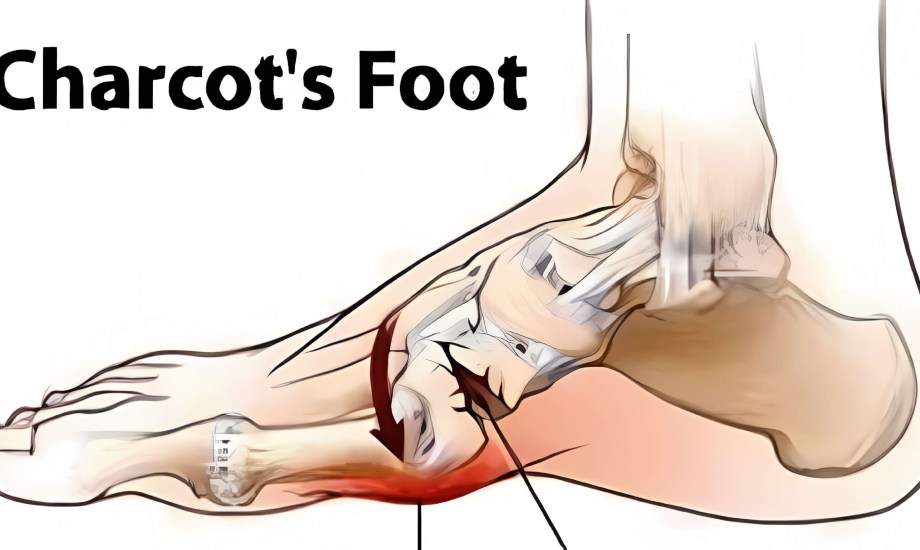 6 عوامل تزيد خطر الإصابة بقدم شاركوت
