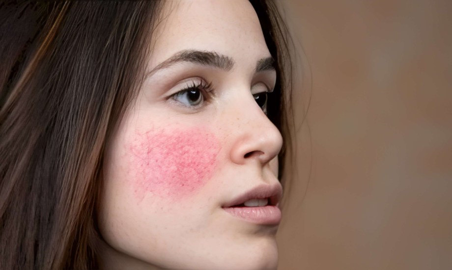 دواء Emrosi لعلاج الوردية