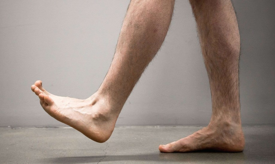 أعراض قدم شاركوت